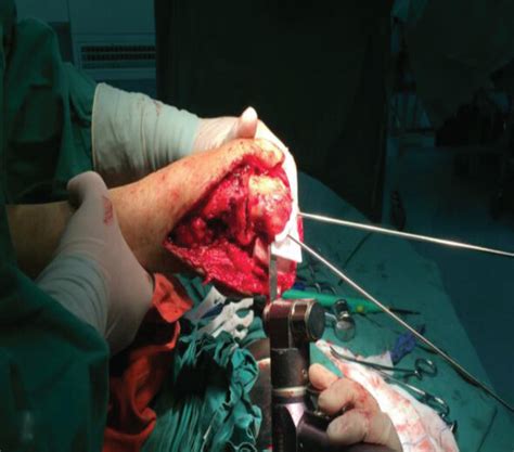 Intraoperative Photographs Of Operation Assisted By The D Printing