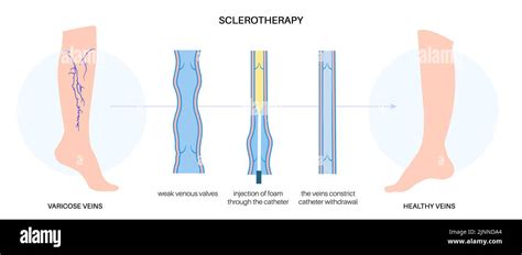 Varicose Vein Treatment Illustration Stock Photo Alamy