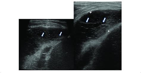 Grayscale Lung Ultrasound Examination Transverse Scan Between