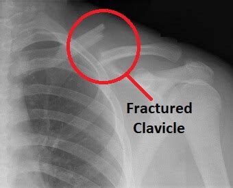 Shoulder Fracture Causes & Treatment - Shoulder Pain Explained