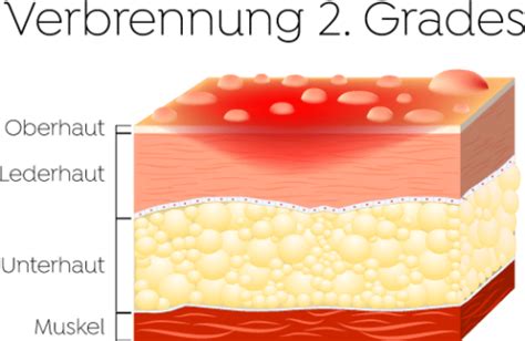 Verbrennungen Was Tun Octenisept