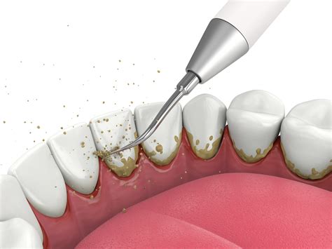 How to Remove Plaque on Teeth - O2 Dental Group