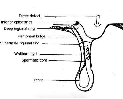 Walthard Cyst Of Spermatic Cord In The Right Inguinal Hernia Bmj Case