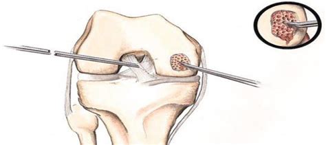 Microfracture 7Scope Ortho Care