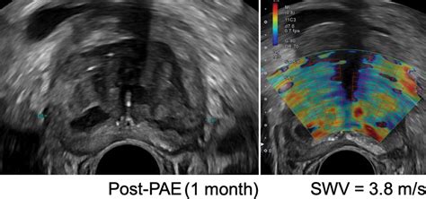 Prostatic Artery Embolization Indications Preparation Techniques