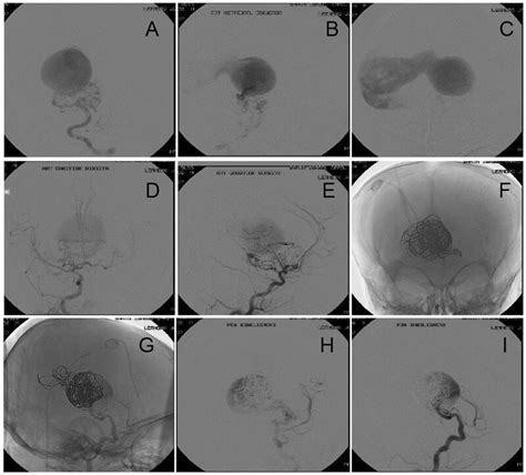 A Arteriography Via The Left Vertebral Artery Revealing A