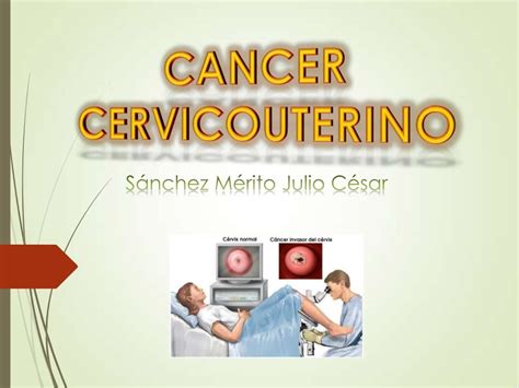 Cáncer Cervicouterino