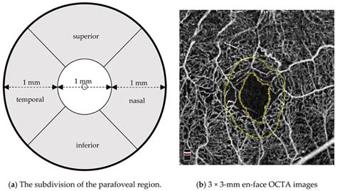 A Schematic Diagram Of The Mm Early Treatment Diabetic Retinopathy