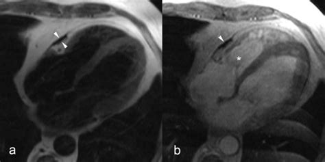 Focal Constrictive Pericarditis Axial T1 Weighted Spin Echo Cmr A