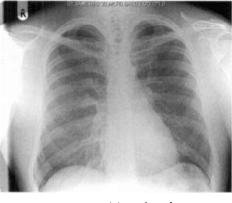 Figure 1 From A 27 Year Old Man Presenting With Acute Chest Pain And