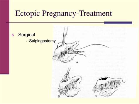 Ppt Ectopic Pregnancy Powerpoint Presentation Free Download Id6916819