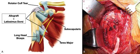 Scielo Brasil Results Of Latissimus Dorsi Transfer Using A Tendinous