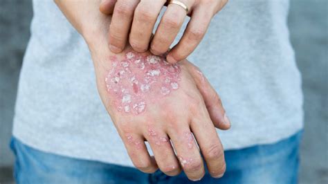 Psoriasis - Symptoms, Types, Causes, Treatment & Prevention | Healthshots