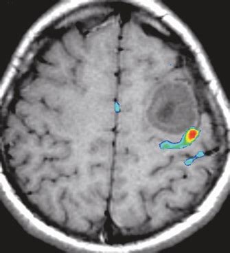 Dr Balaji Anvekar FRCR: Functional MRI