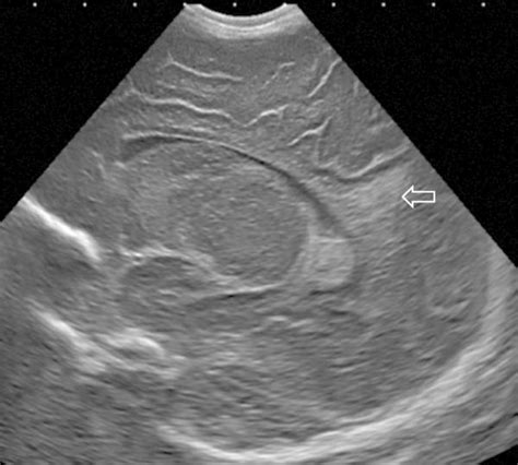 3 Neonatal Cranial Ultrasonography Radiology Key