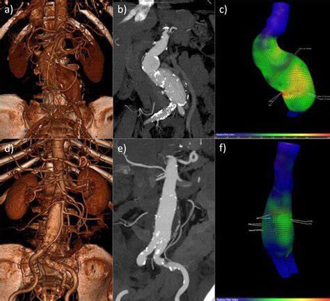 Abdominal Aortic Aneurysm Sex Differences Maturitas