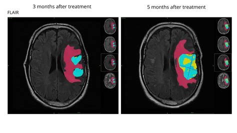 Automatic Brain Tumor Segmentation With Subregions Graylight Imaging