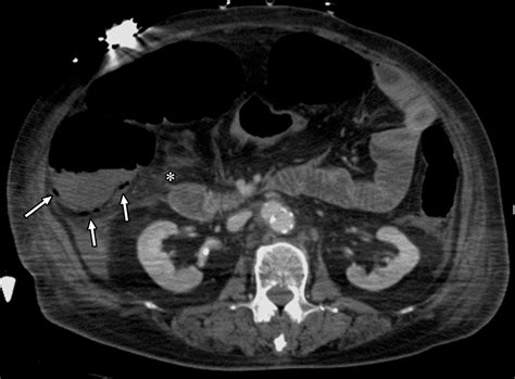 Acute Mesenteric Ischemia Multidetector Ct Findings And Endovascular