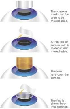 The Truth Behind Lasik Eye Surgery – Medchrome