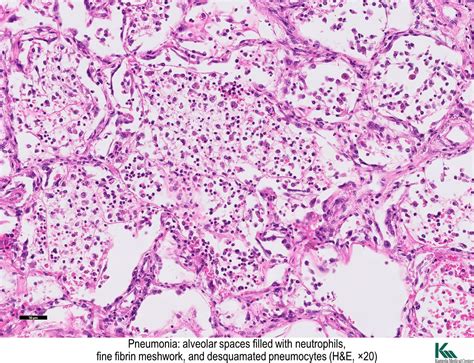 Pathology Outlines - Pneumonia