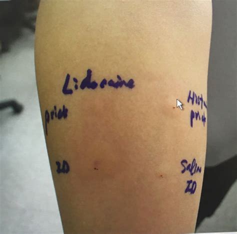 Skin Prick Test Positive Skin Reaction To Lidocaine Download