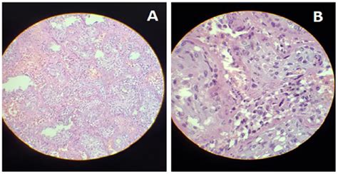 Histological Findings A Placenta Low Resolution Extensive Deposition