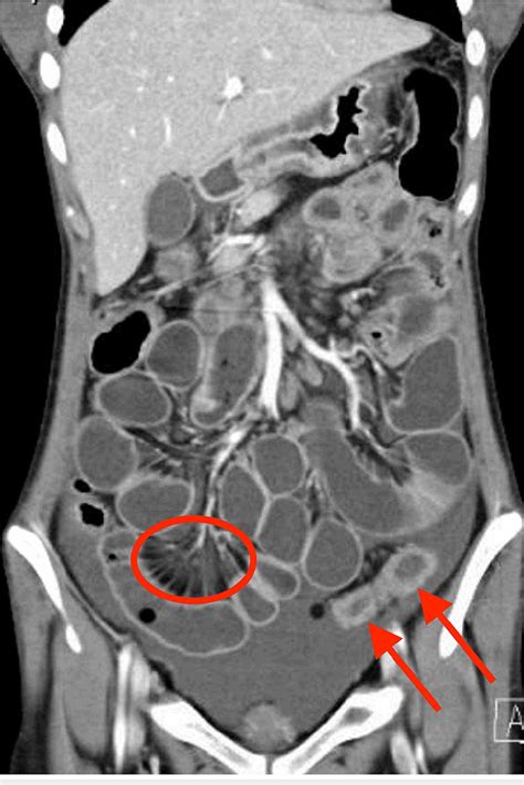 Figure From Mesenteric Vasculitis And Urinary System Involvement