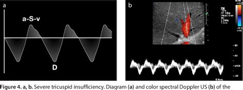 Figure 4 From Congestive Hepatopathy The Role Of The Radiologist In The Diagnosis Semantic