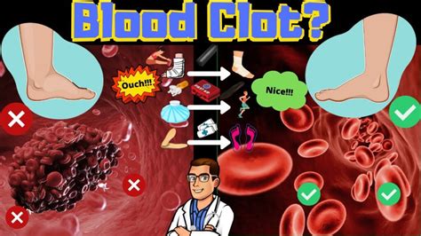 Blood Clot Symptoms & Signs [Causes & Treatment of Leg blood clots]