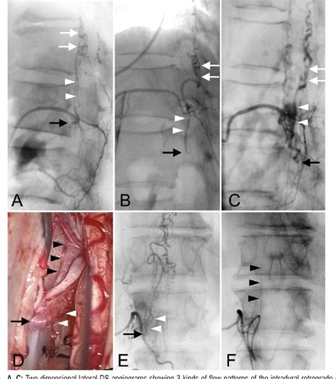 Figure 3 From Three Dimensional Angioarchitecture Of Spinal Dural