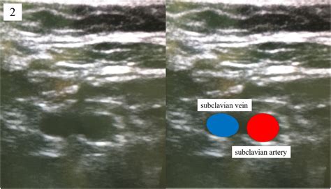 Real Time Ultrasound Guided Supraclavicular Technique As A Possible