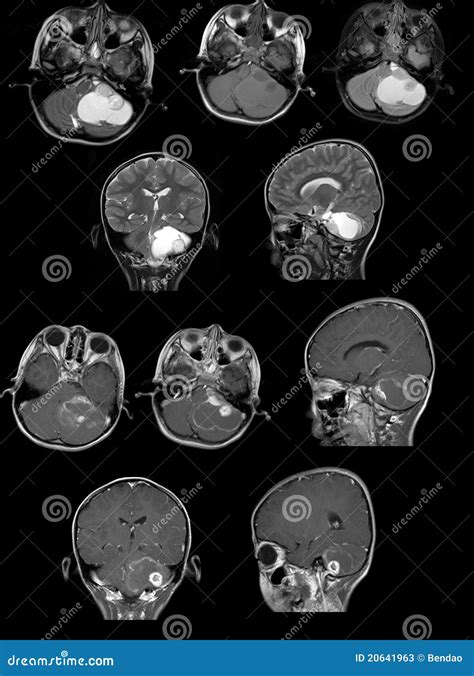 MRI Image Show a Tumour in Cerebellum Stock Image - Image of medical ...