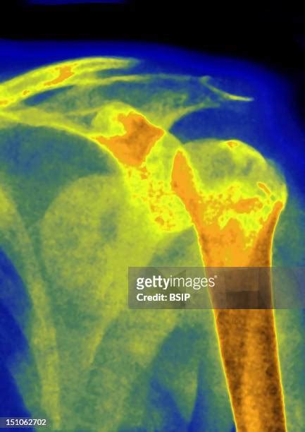 Shoulder Dislocation X Ray Photos and Premium High Res Pictures - Getty ...