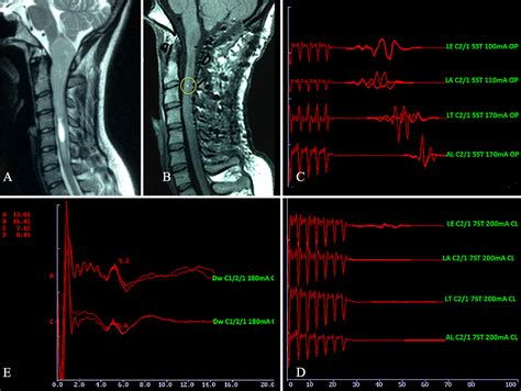 Surgery For Intramedullary Spinal Cord Ependymomas In The