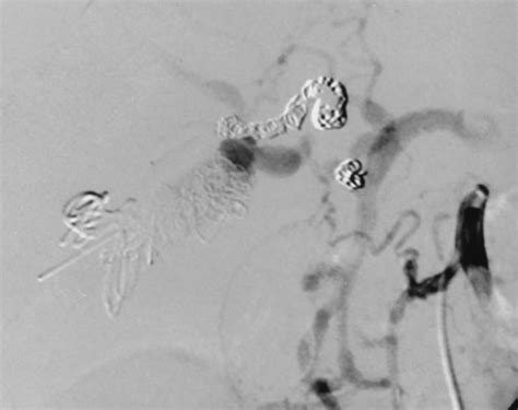 Selective Sma Arteriogram Demonstrating Successful Embolization Of The