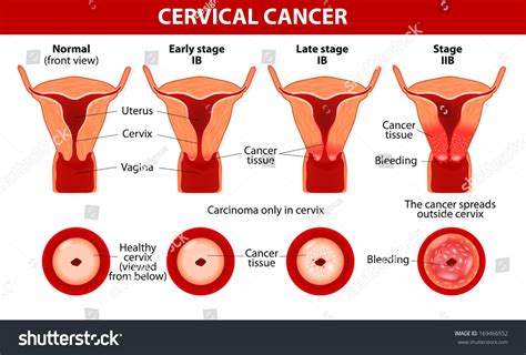 Cervical Cancer Carcinoma Of Cervix Malignant Neoplasm Arising From