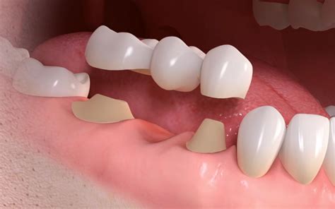 Dental Bridge Affordable And Fixed Missing Teeth Replacement