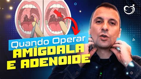 QUANDO É NECESSÁRIO OPERAR A AMÍGDALA E ADENOIDE YouTube