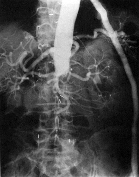 Axillofemoral Bypass Thoracic Key