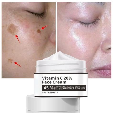 Effective Whitening Freckle Cream Remove Melasma Acne Spot Pigment