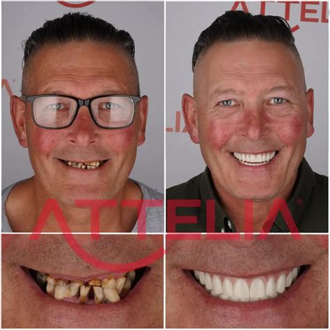 Multi Unit Abutment F R Zahnimplantate Attelia Dental T Rkei Global