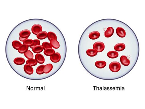 Thalassemia Heres All You Need To Know About The Blood Disorder