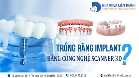 Công nghệ scan lấy dấu răng 3D Ứng dụng đồng bộ kĩ thuật số trong