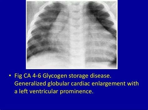 4 left ventricular enlargement