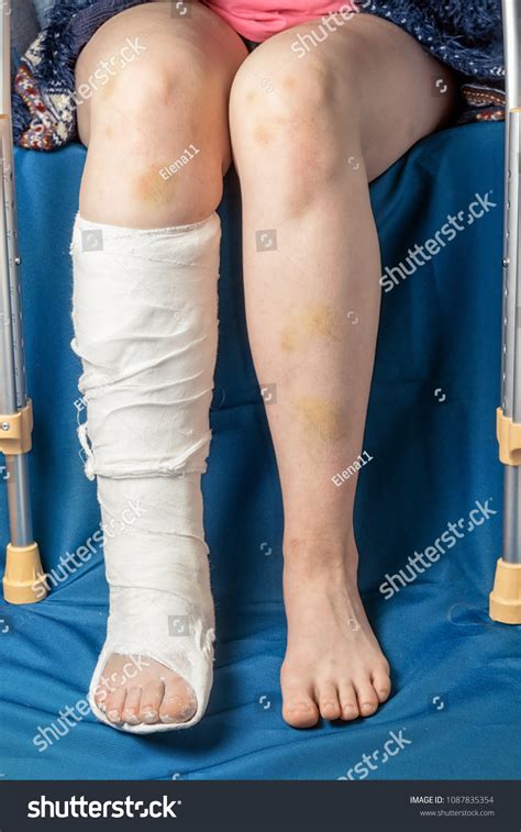 Leg Fracture Gypsum Crutches Close Only Stock Photo