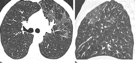 Pneumocystis Carinii Pneumonia In A 31 Year Old Hiv Positive Man A Download Scientific