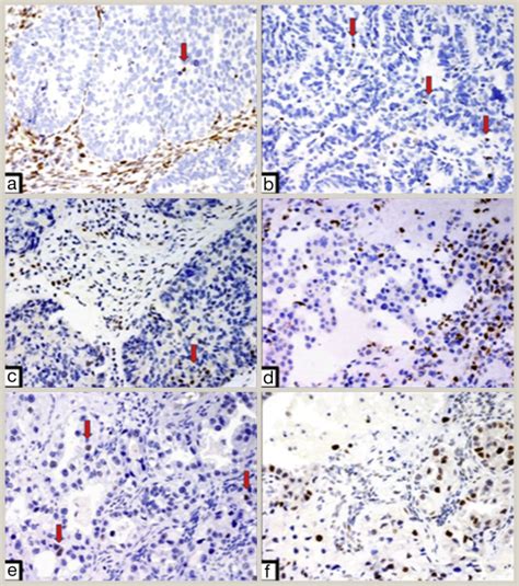 Interpretation Of P16 P53 And Mismatch Repair Protein Immunohistochemistry In Gynaecological