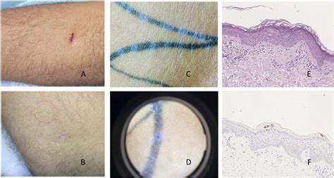 Efflorescence Of Acquired Epidermodysplasia Verruciformis Due To Immune