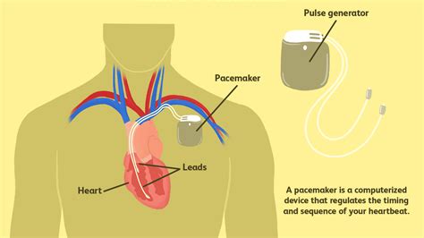 Icd Vs Pacemaker : Anesthesia And Cardiac Pacemaker : (hence, medicine) a medical implement that ...