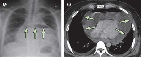 Cardiac Tamponade X Ray